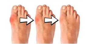 Silicone Hammer Toe Corrector